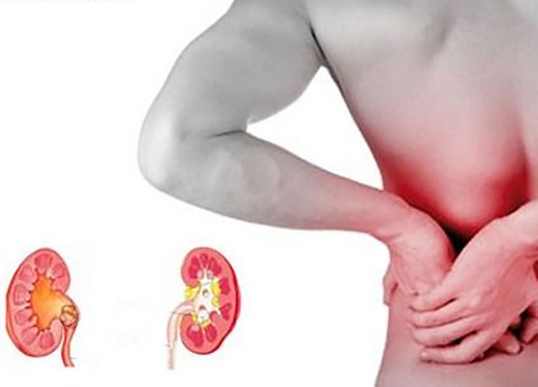 چرا ایرانیان سنگ کلیه میگیرند؟