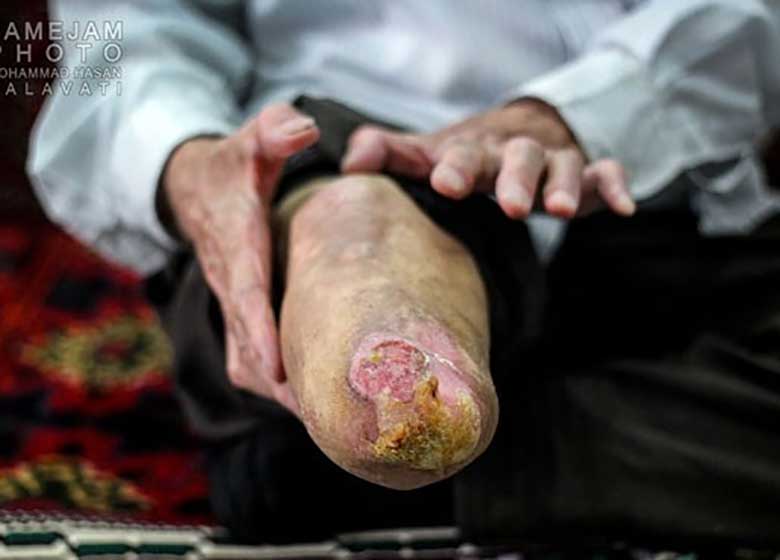 گزارشی تکاندهنده از شهرک جذامیهای مشهد