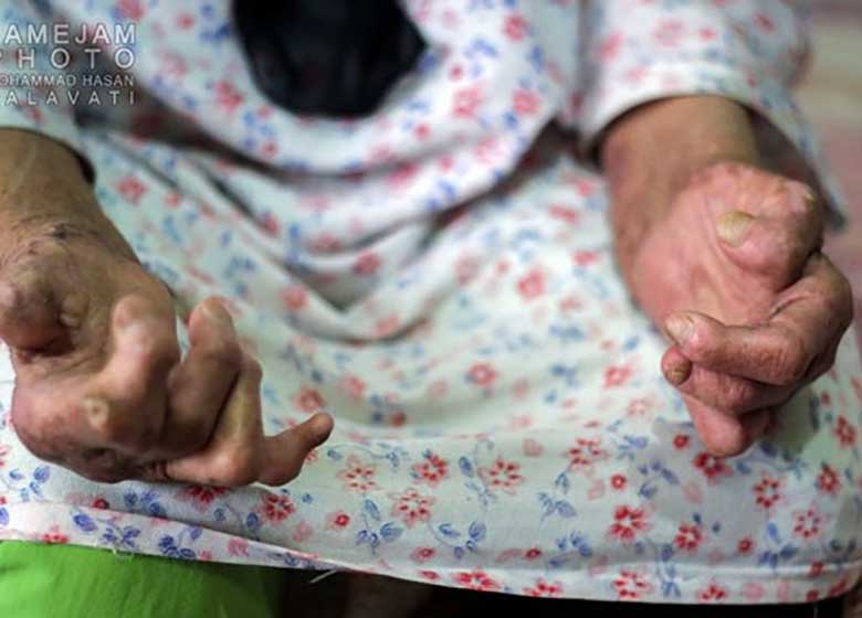 گزارشی تکاندهنده از شهرک جذامیهای مشهد