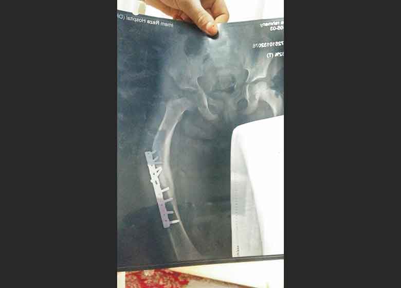 قطع پای دختر۵ ساله فقط به خاطر ۷ میلیون تومان + تصاویر