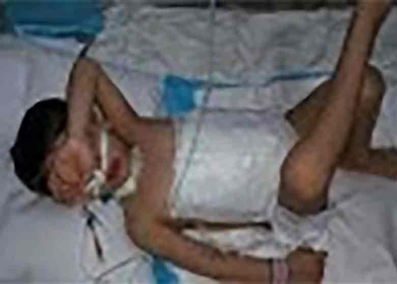 کودک 5 ساله خراسان شمالی که توسط سگ دریده شده بود، درگذشت