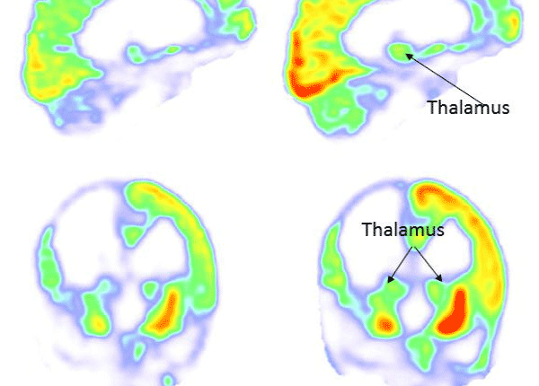 بیماری بعد از ۱۵ سال زندگی نباتی، به درمان پاسخ داد