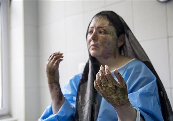 دومین اسید پاشی در تبریز /مریم در اسید سوخت+تصاویر