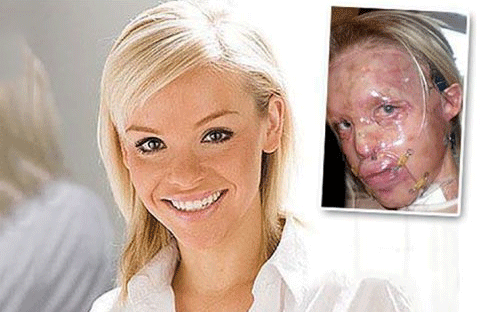 مجری زن مشهوری که قربانی اسید پاشی شد!/عکس