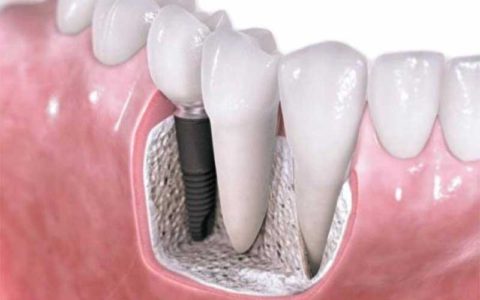 طراحی ایمپلنت دندانی با توجه به ابعاد استخوانی هر فرد 1 طراحی ایمپلنت دندانی با توجه به ابعاد استخوانی هر فرد