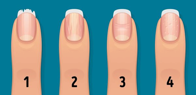 هر آنچه ناخن ها درباره سلامتی بدن می گویند