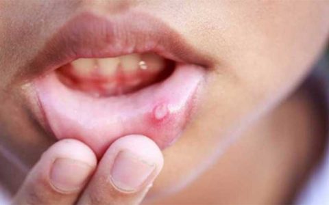 کدام زخمهای دهانی خطرناک هستند؟
