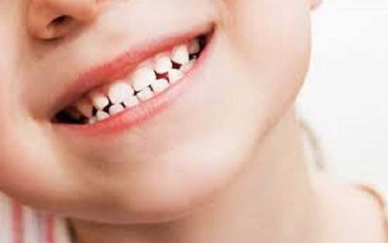 نکاتی که والدین باید در مورد دندان های شیری کودکان بدانند