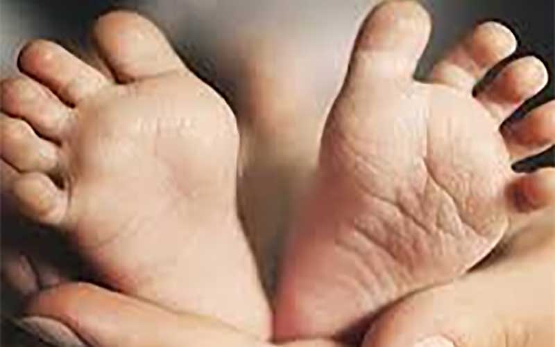 تولد نوزاد قمی با توده ۳۰کیلوگرمی