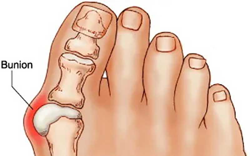 علت انحراف شست پا چیست؟