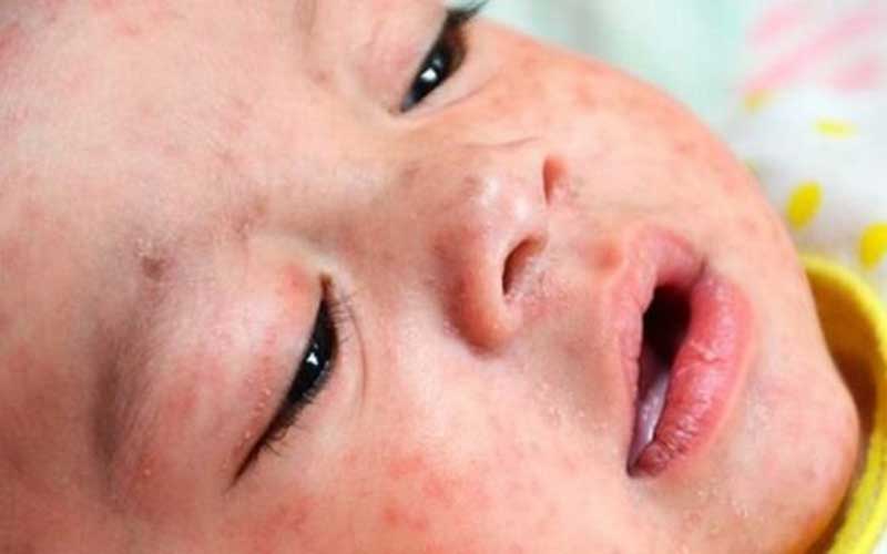 افزایش ۳ برابری مبتلایان به سرخک در جهان