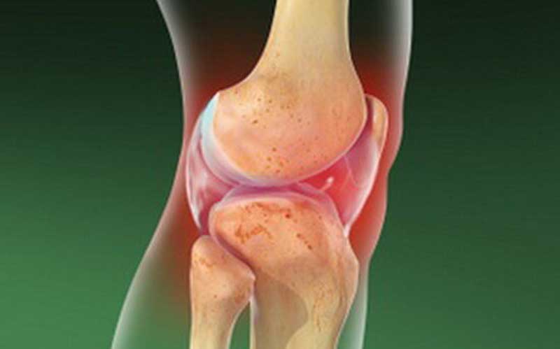 آرتریت سپتیک چیست و چه علائمی دارد؟