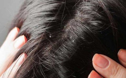 شپش نشانه وضعیت بد اجتماعی و اقتصادی نیست 1 شپش نشانه وضعیت بد اجتماعی و اقتصادی نیست