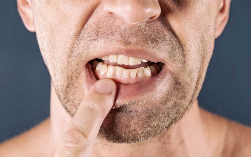 خونریزی مهمترین علامت آغاز بیماری لثه است