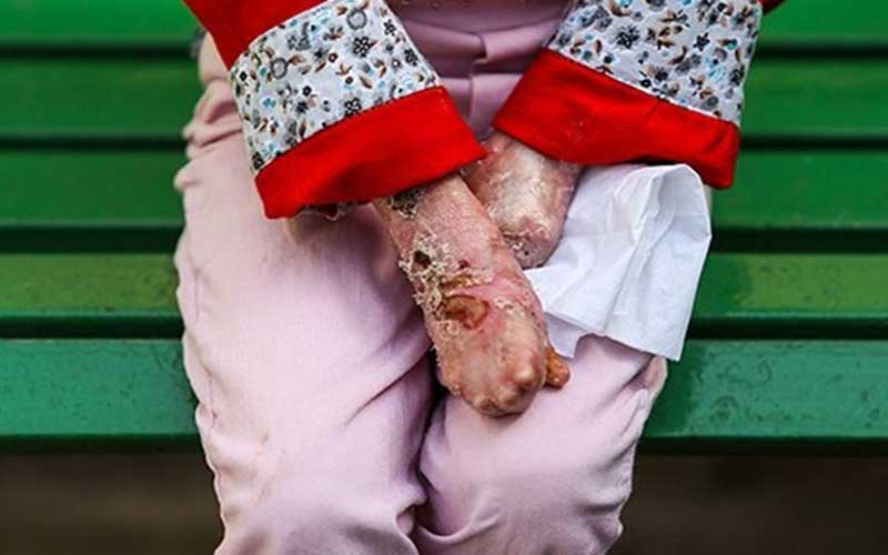 مظلومیت «کودکان EB» در ایران باید به گوش جهانیان برسد