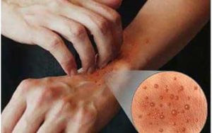 راهکارهایی برای پیشگیری از تشدید اگزما در زمستان