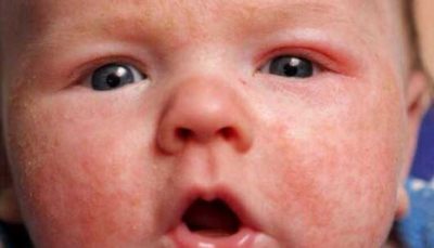 نوزادان در برابر سرخک مصون نیستند