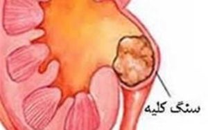 کشف-داروی-جدید-برای-دفع-راحت‌تر-«سنگ-کلیه»