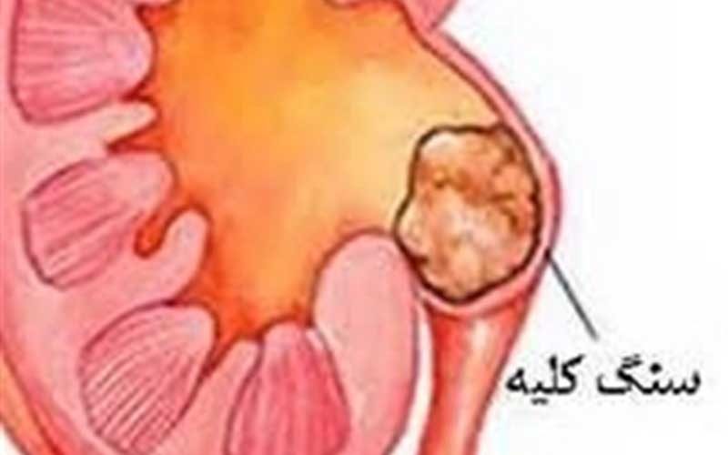 کشف-داروی-جدید-برای-دفع-راحت‌تر-«سنگ-کلیه»