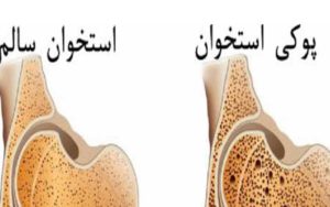 «شکستگی‌-مرضی»-چیست؟