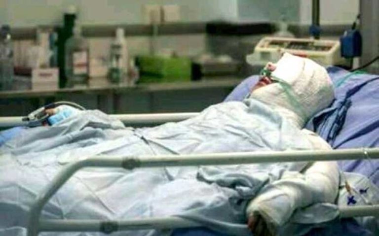 احتمال-ابتلا-به-کرونا-در-افراد-دچار-سوختگی-بیشتر-است