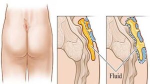 درد دنبالچه نشانه چیست؟ بررسی عوامل و علائم