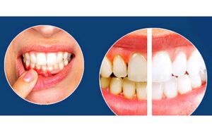 علل،-علایم-و-درمان-پیوره-لثه