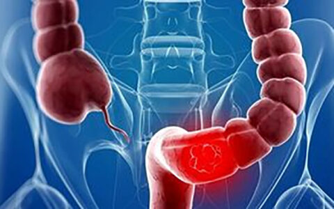 افزایش ریسک زوال عقل با بیماری کولیت روده 1 افزایش ریسک زوال عقل با بیماری کولیت روده