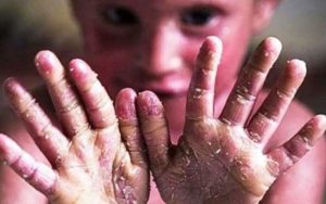 پانسمان-مورد-نیاز-بیماران-پروانه‌ای-با-پست-ارسال-می‌شود