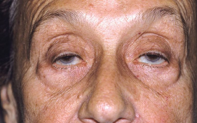 جدیدترین-علائم-ابتلا-به-کرونای-شدید؛-از-فلج-شدن-صورت-تا-افتادن-پلک‌ها