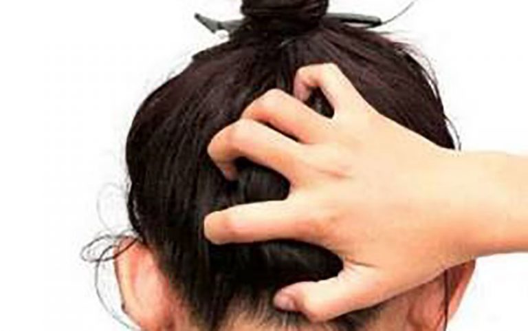 علل-خارش-کف-سر-و-راههای-درمان-آن