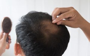 راهکار-جدید-متخصصان-برای-درمان-ریزش-مو