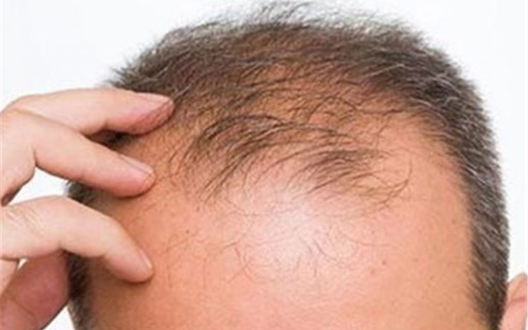 راهکارهای-طب-سنتی-برای-جلوگیری-از-ریزش-مو