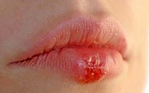 را سه دقیقه ای درمان کنید