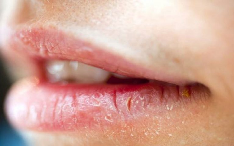 چرا-گوشه-لب‌ها-ترک-می‌خورد؟