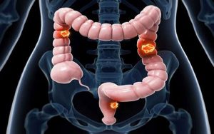 چگونه-از-پیشرفت-سرطان-روده-بزرگ-جلوگیری-کنیم؟