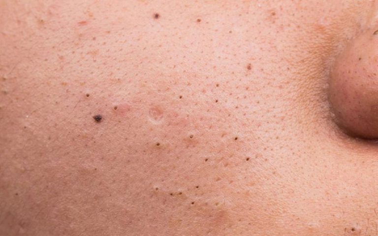 رفع جوش‌های سرسیاه
