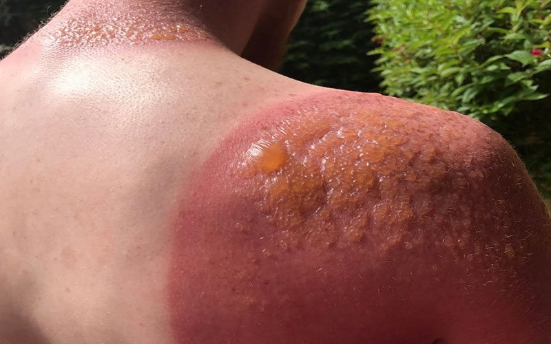 خطرات آفتاب سوختگی و راهکار‌های التیام آن