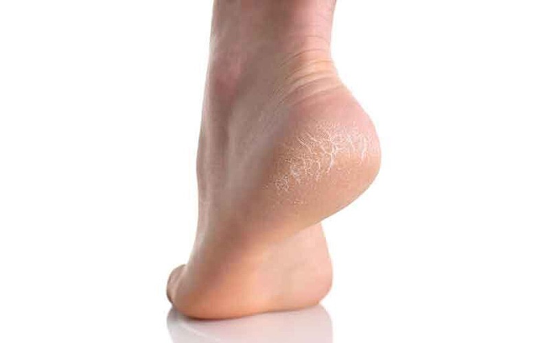 چگونه ترک‌های پوستی را از بین ببریم؟