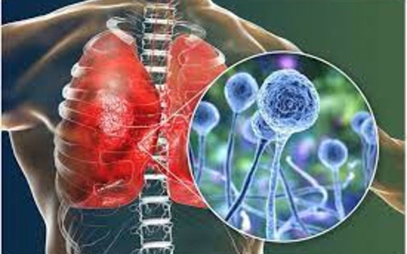 بستری شدن ۱۰ کرونایی مبتلا به "قارچ سیاه" در تهران