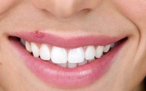 چند توصیه بهداشتی درباره تبخال