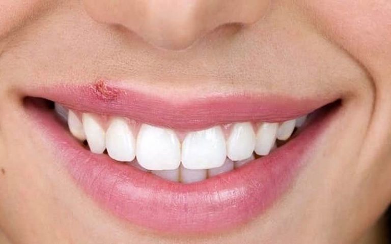چند توصیه بهداشتی درباره تبخال