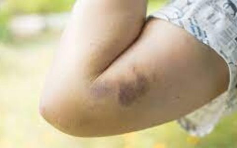 5 دلیل احتمالی کبودی در بدن 1 5 دلیل احتمالی کبودی در بدن