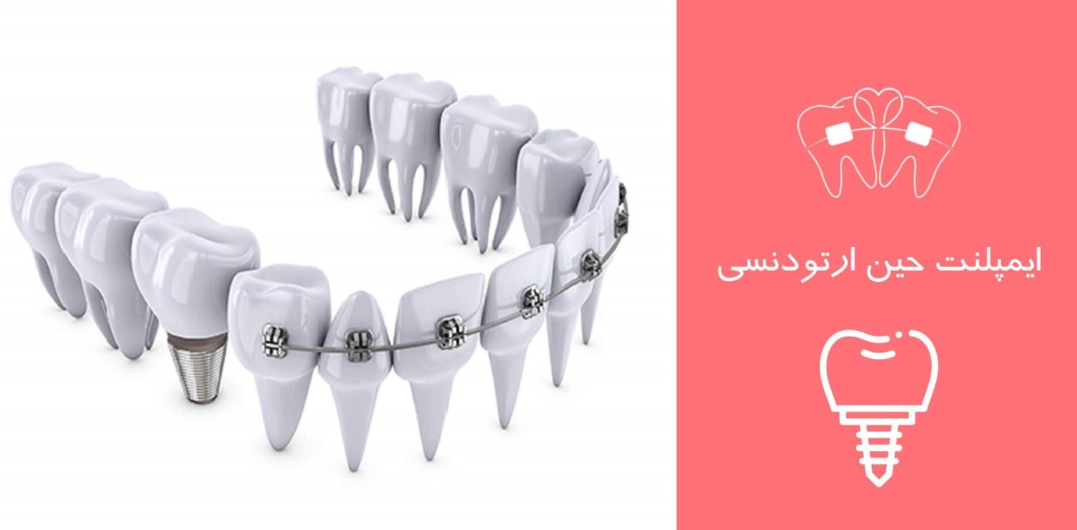 ایمپلنت حین ارتودنسی