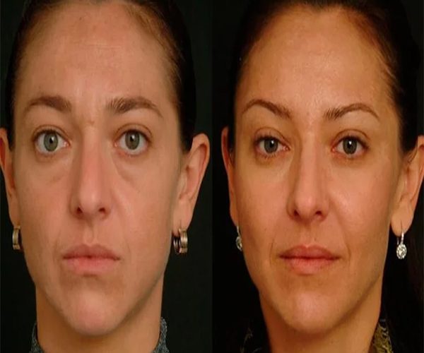تزریق چربی و همه چیز در مورد آن 1 تزریق چربی و همه چیز در مورد آن