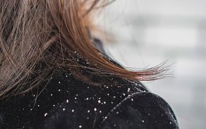 با این ترفند ساده شوره سر را درمان کنید
