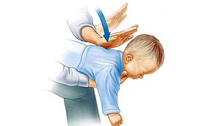 در صورت پریدن اشیا در گلوی کودک چه کار باید کنیم؟
