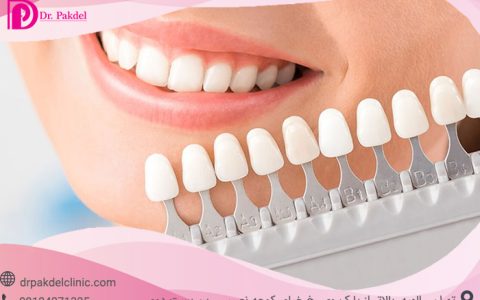Dental-composite-12