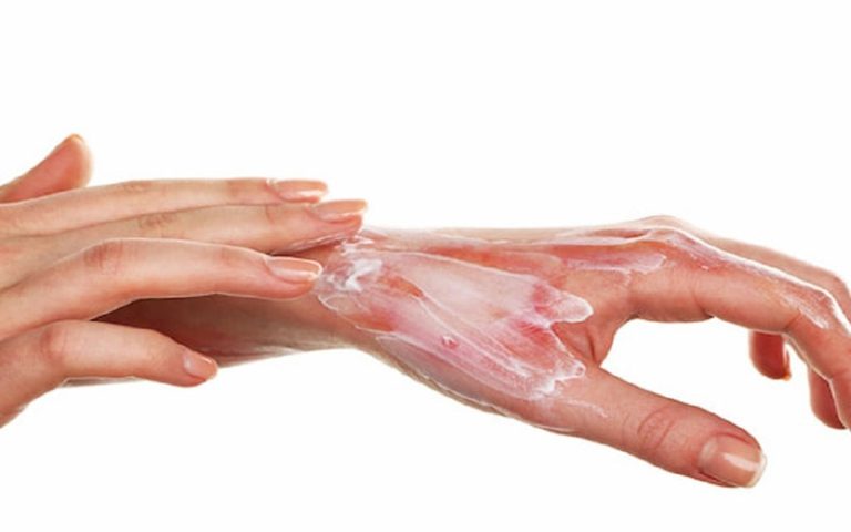 باورهای اشتباه در برخورد با سوختگی