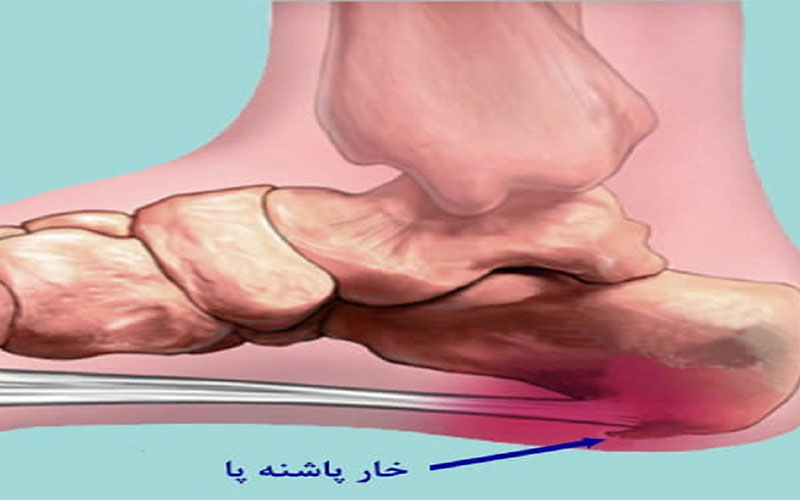 راه‌های درمان خارپاشنه بدون جراحی